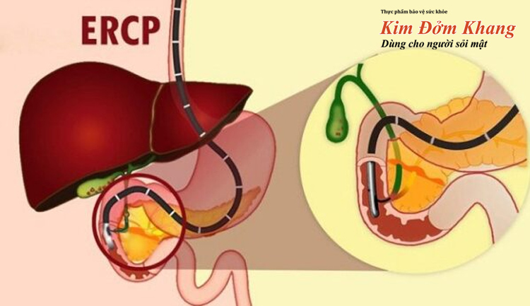 ERCP (nội soi mật tụy ngược dòng) sẽ giúp chẩn đoán bệnh sỏi đường mật